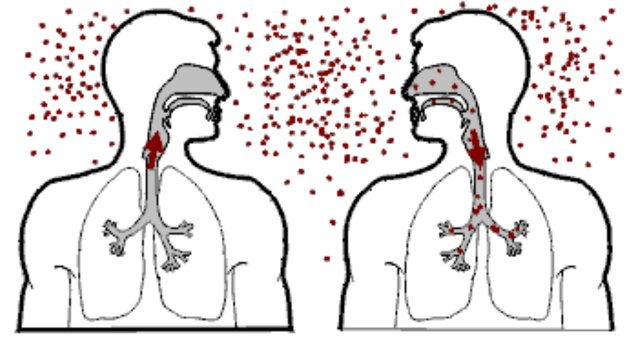 Tuberculosis